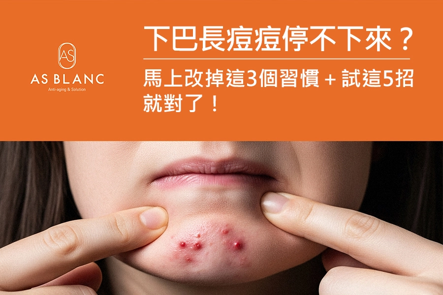 一位女性的下巴長痘痘，兩隻手食指輕輕按壓在痘痘旁的皮膚上